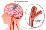 Phương pháp mới hỗ trợ điều trị thiểu năng tuần hoàn não 