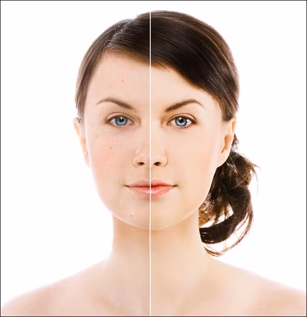 Tuy nhiên, ít ai biết sự có mặt của P.acnes góp phần tạo nên một làn da khỏe mạnh. Chúng tiết ra một loại enzyme có tác dụng phá vỡ chất béo trong bã nhờn, nhờ thế chất nhờn trên mặt sẽ giống như một loại chất dưỡng ẩm. Ngoài ra, khuẩn P.acnes còn gia tăng tính axit trên da nhằm giảm nguy cơ nhiễm những khuẩn nguy hiểm hơn như tụ cầu vàng (staphylococcus aureus) hoặc liên cầu khuẩn Streptococcus pyogenes (khuẩn ăn thịt). Tuy nhiên, ít ai biết sự có mặt của P.acnes góp phần tạo nên một làn da khỏe mạnh. Chúng tiết ra một loại enzyme có tác dụng phá vỡ chất béo trong bã nhờn, nhờ thế chất nhờn trên mặt sẽ giống như một loại chất dưỡng ẩm. Ngoài ra, khuẩn P.acnes còn gia tăng tính axit trên da nhằm giảm nguy cơ nhiễm những khuẩn nguy hiểm hơn như tụ cầu vàng (staphylococcus aureus) hoặc liên cầu khuẩn Streptococcus pyogenes (khuẩn ăn thịt).